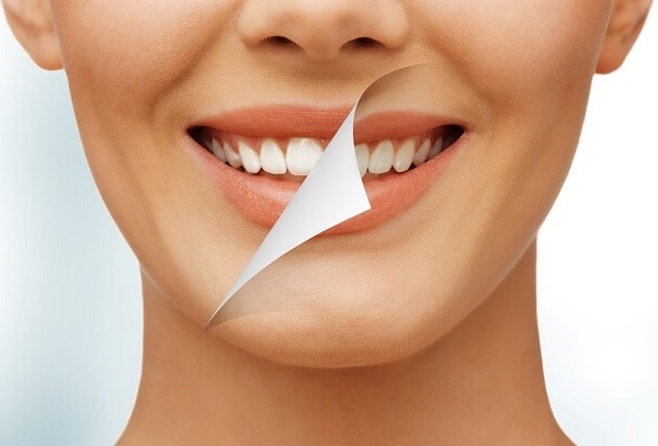 Tẩy trắng răng thường không làm ảnh hưởng đến men răng