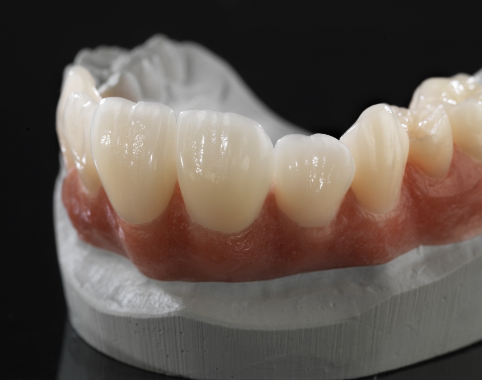 Răng sứ Ceramill có màu trắng trong, độ trong mờ, cảm giác rất giống với răng thật