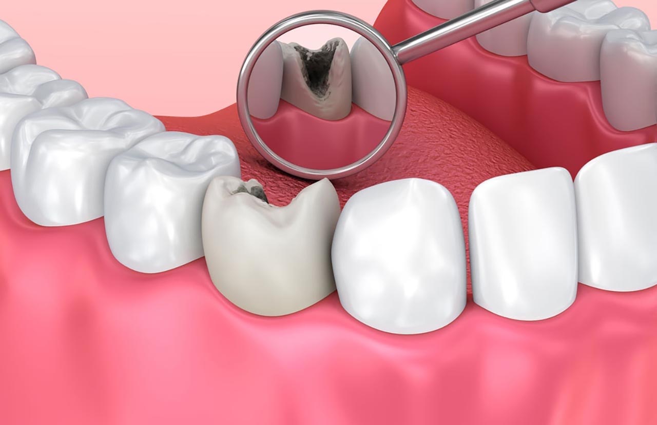 Răng sâu thường diễn ra ở bề mặt thân răng và chân răng,